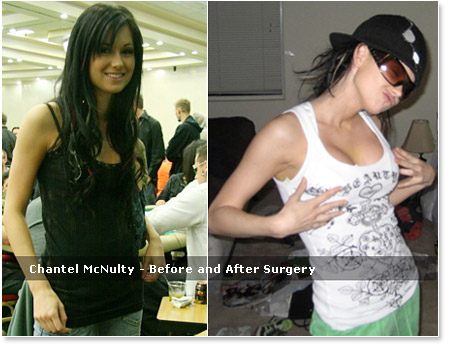 Chantel McNulty boob job pics